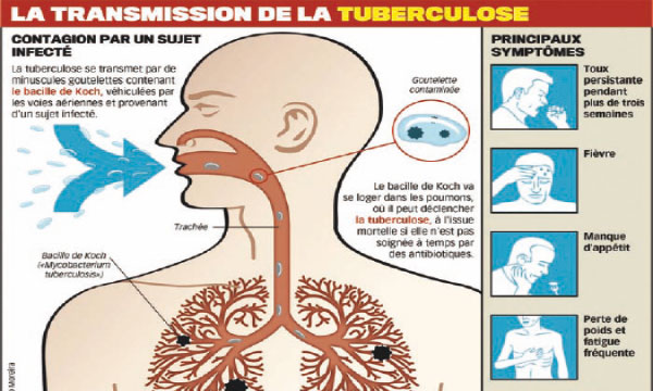 Vd La Tuberculose A Fait Son Retour En Classe Les Observateurs