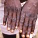 L’OMS veut changer le nom de la variole du singe pour lutter contre le « racisme » et la « stigmatisation »