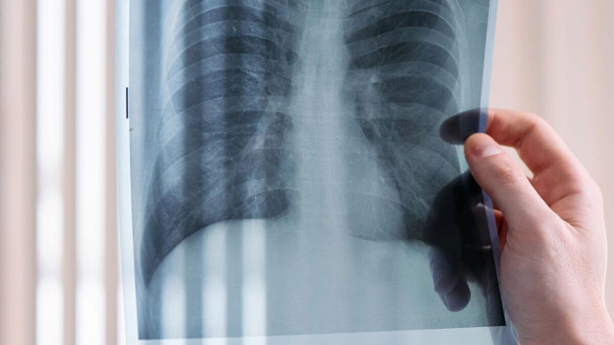 Retour de la tuberculose en Suisse : la hausse vient surtout des migrations