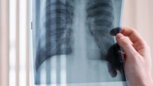 Retour de la tuberculose en Suisse : la hausse vient surtout des migrations