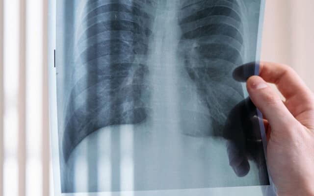 Retour de la tuberculose en Suisse : la hausse vient surtout des migrations